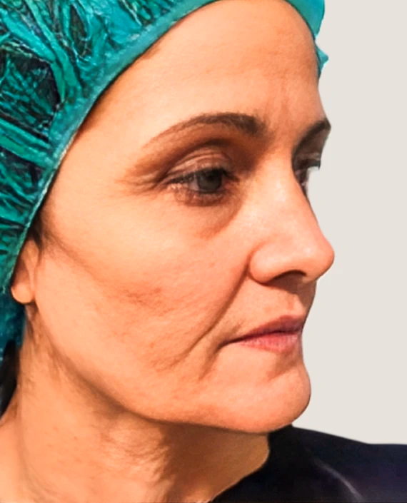 Antes de Abans i després del lifting facial