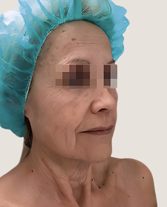 Antes de Abans i després del lifting facial