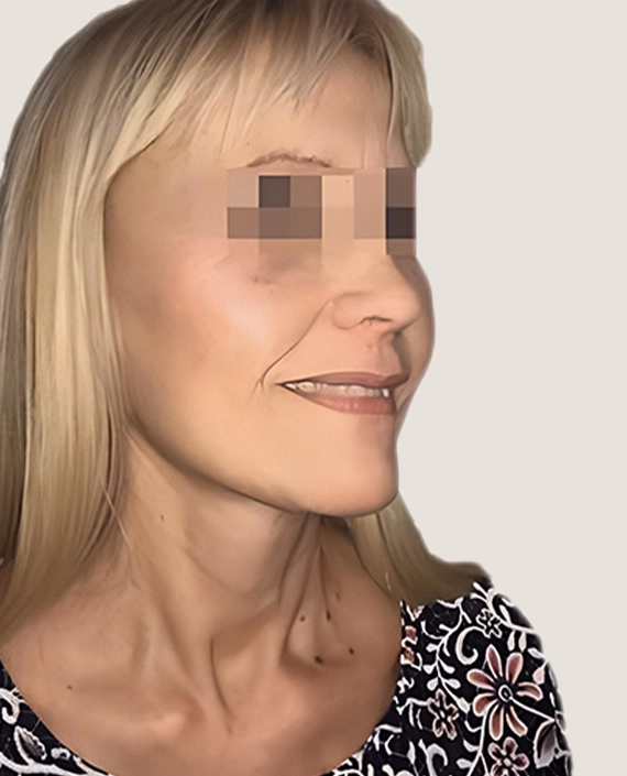 Después de Abans i després del lifting facial