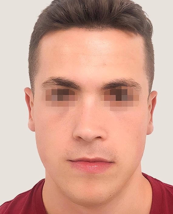 Después de Otoplastia