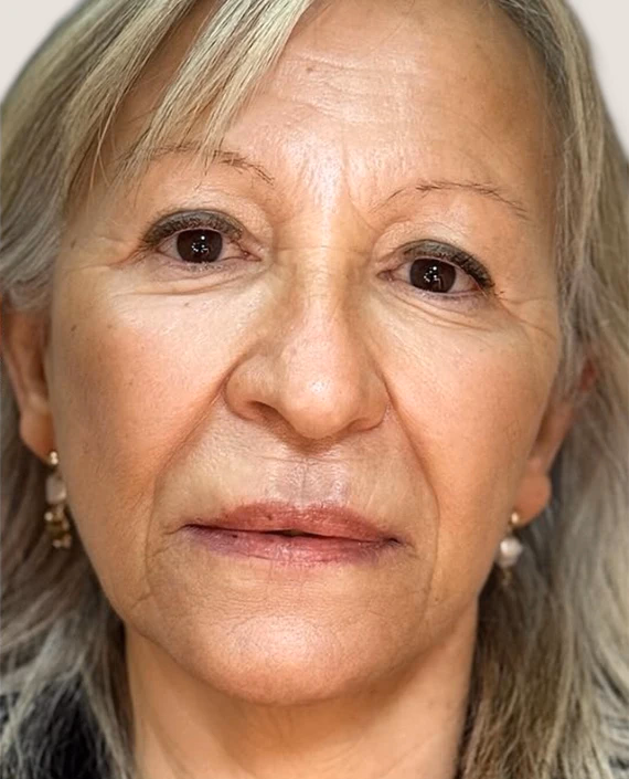 Después de Rejoveniment facial
