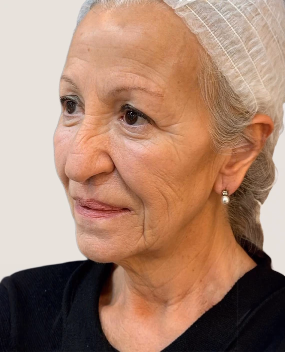 Antes de Rejoveniment facial