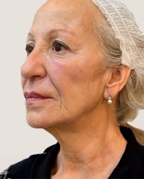 Después de Rejoveniment facial