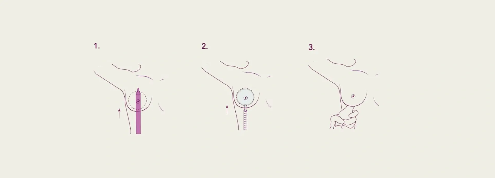 Preservé: la tècnica minimalista que cuida la teva sensibilitat mamària