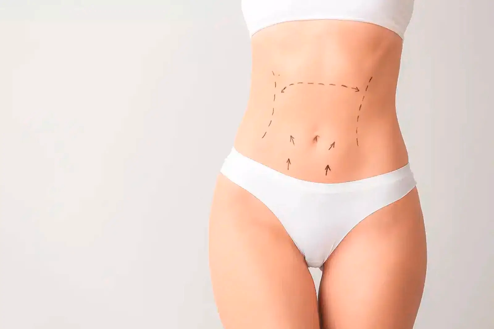 Evolución de la cicatriz de una abdominoplastia