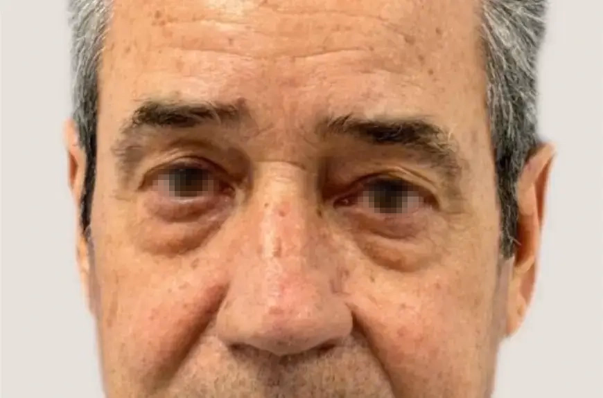 Antes de abans i després d'una blefaroplàstia