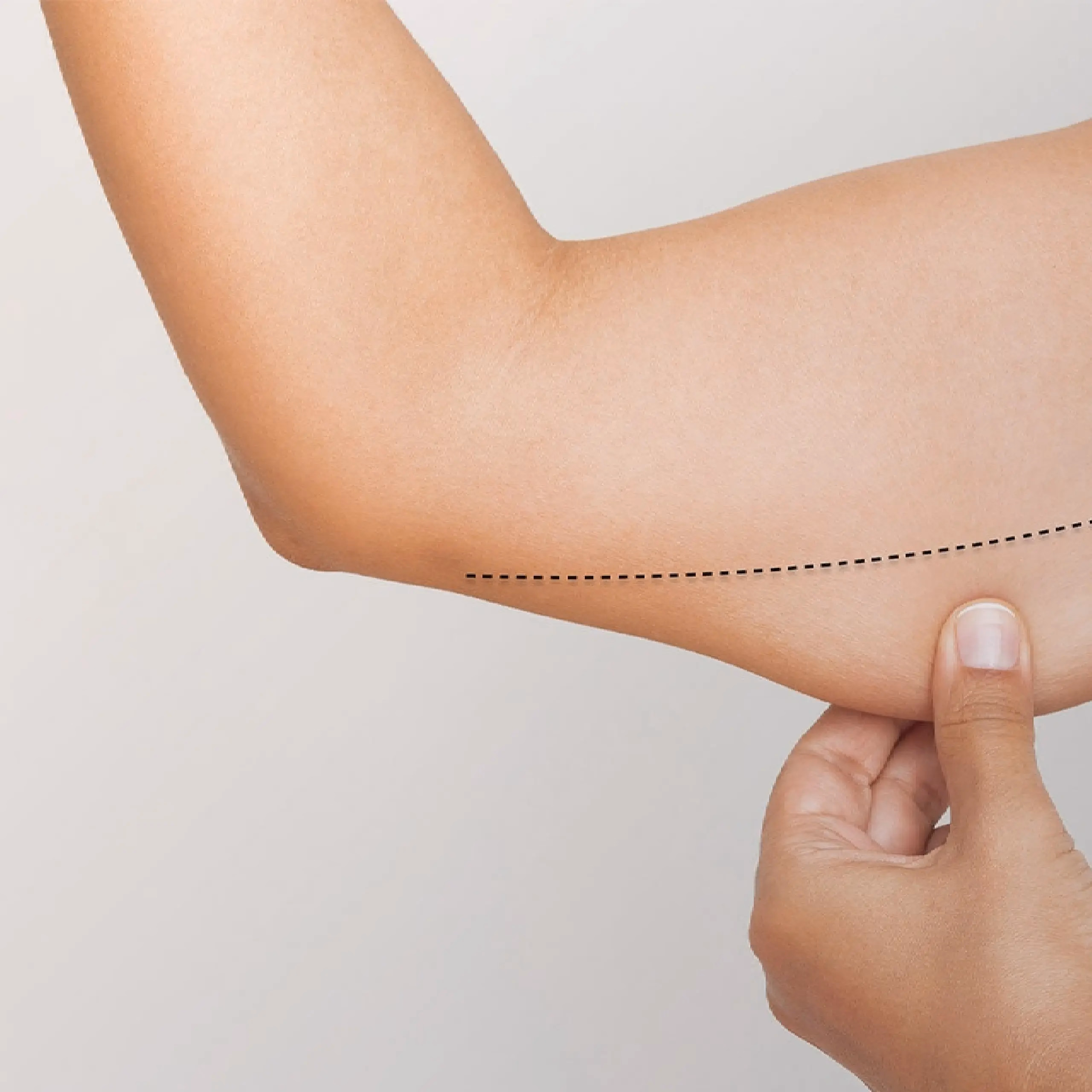 Ideal candidate for brachioplasty