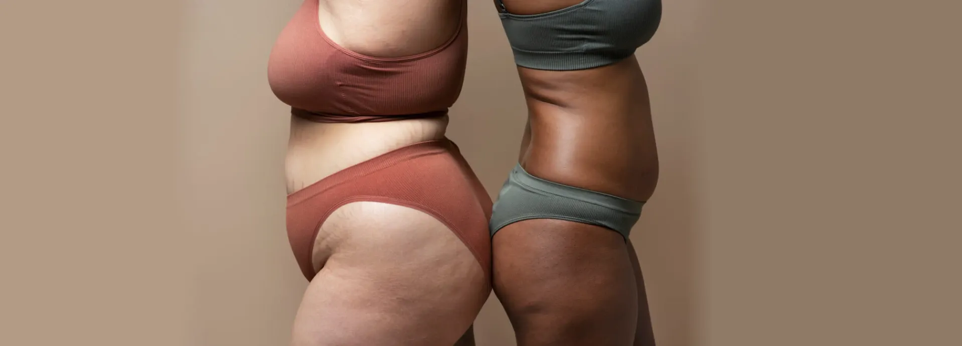 Todo sobre el lipedema: qué es y cómo se trata