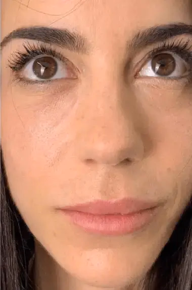 Después de Micropigmentación Ojeras