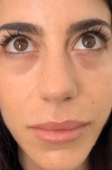 Antes de Micropigmentación Ojeras