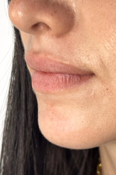 Antes de Micropigmentación de Labios