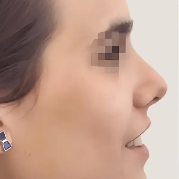Después de Rinoplastia secundaria