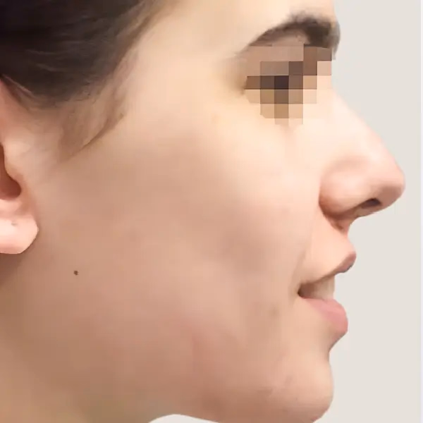Antes de Rinoplastia secundaria