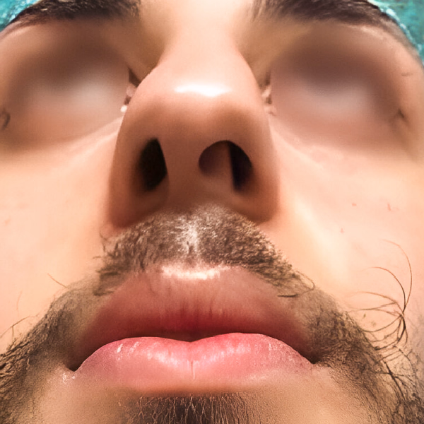 Antes de Rinoplastia secundaria