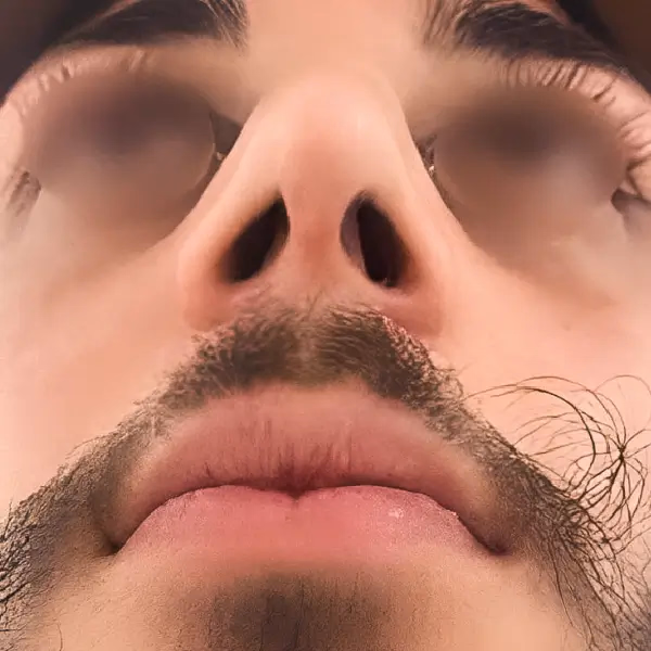 Después de Rinoplastia secundaria