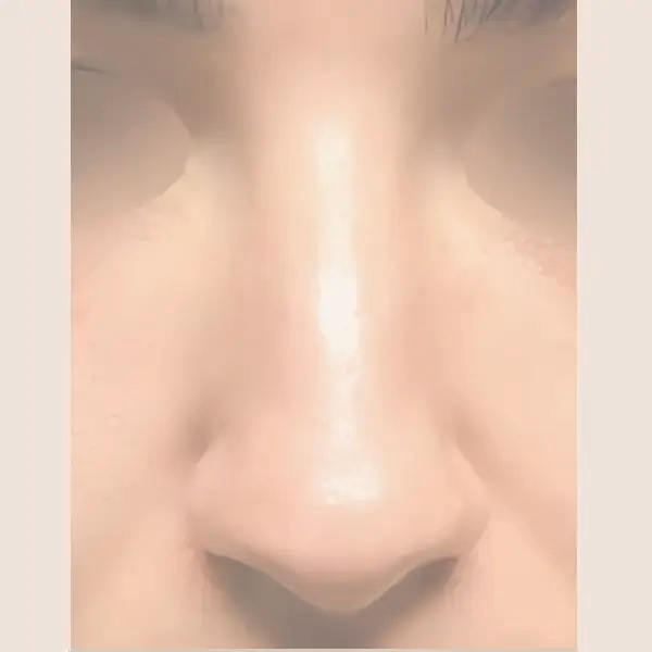 Antes de Rinoplastia secundaria