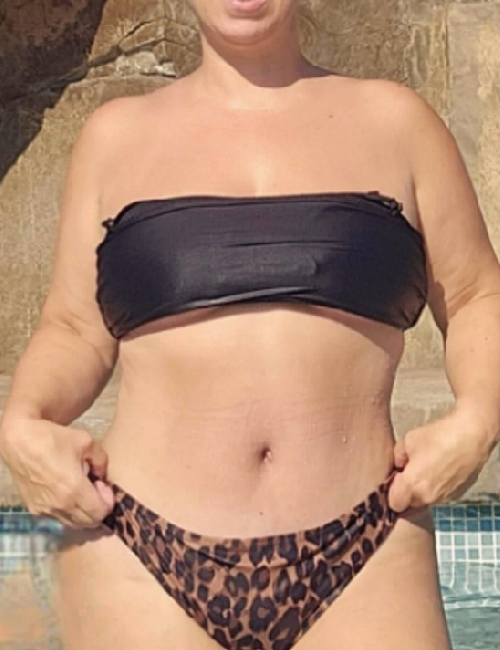 Después de Liposucció VASER