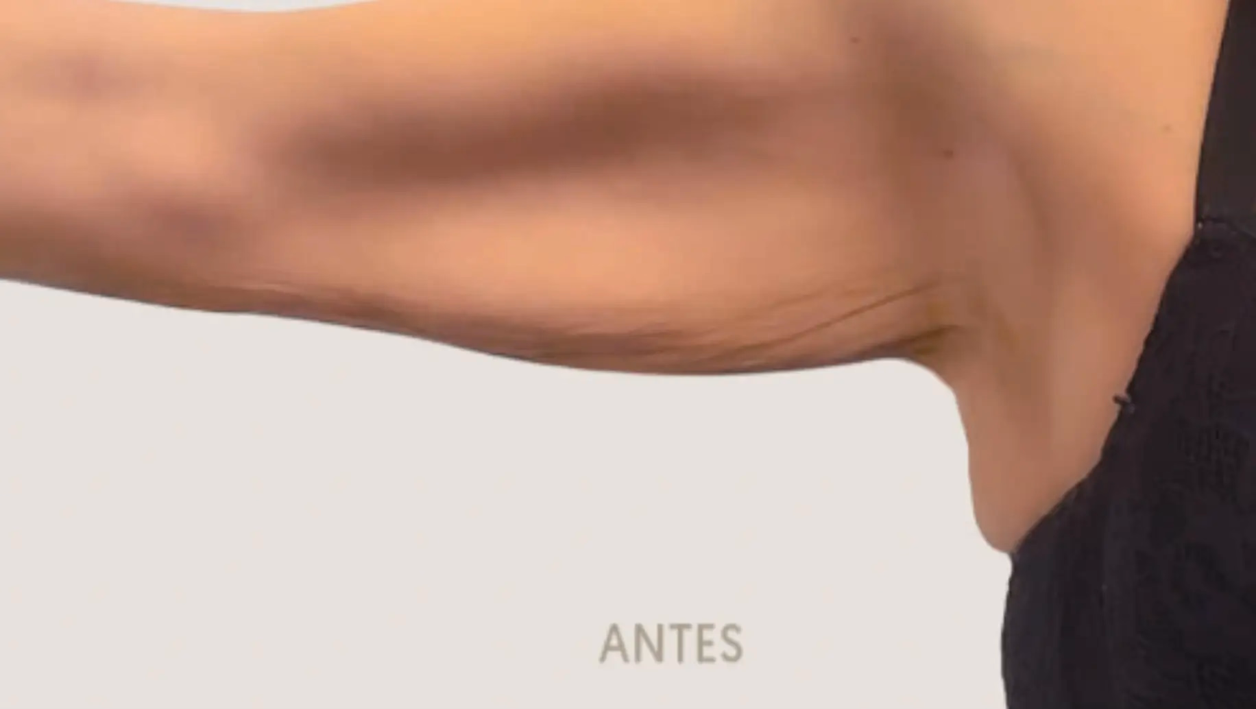 Antes de Brachioplasty