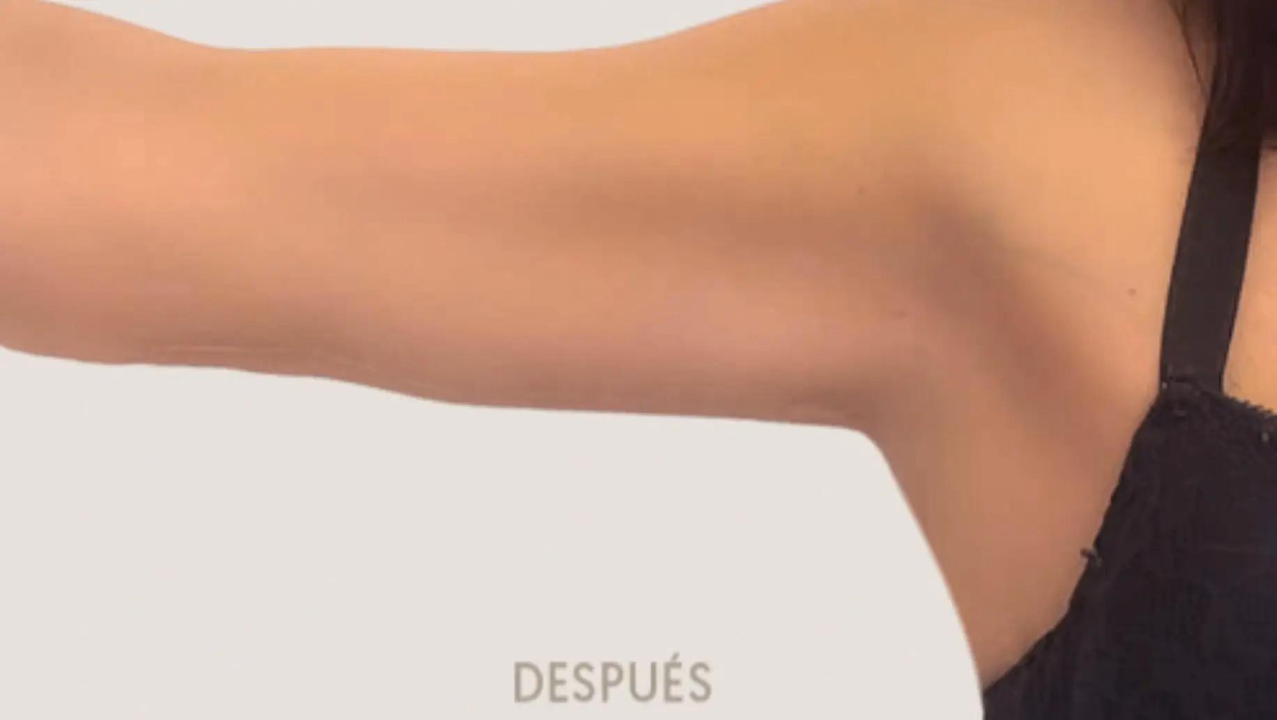 Después de Brachioplasty