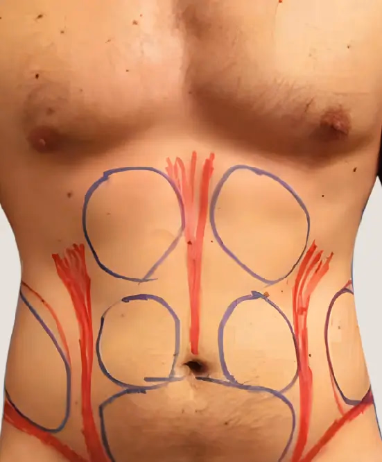 Antes de Lipoescultura