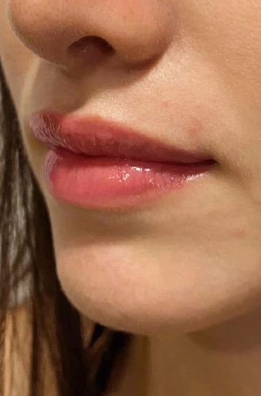 Después de Micropigmentación de Labios