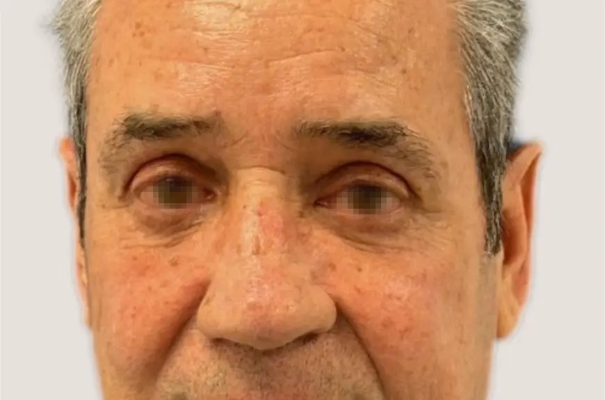 Después de abans i després d'una blefaroplàstia