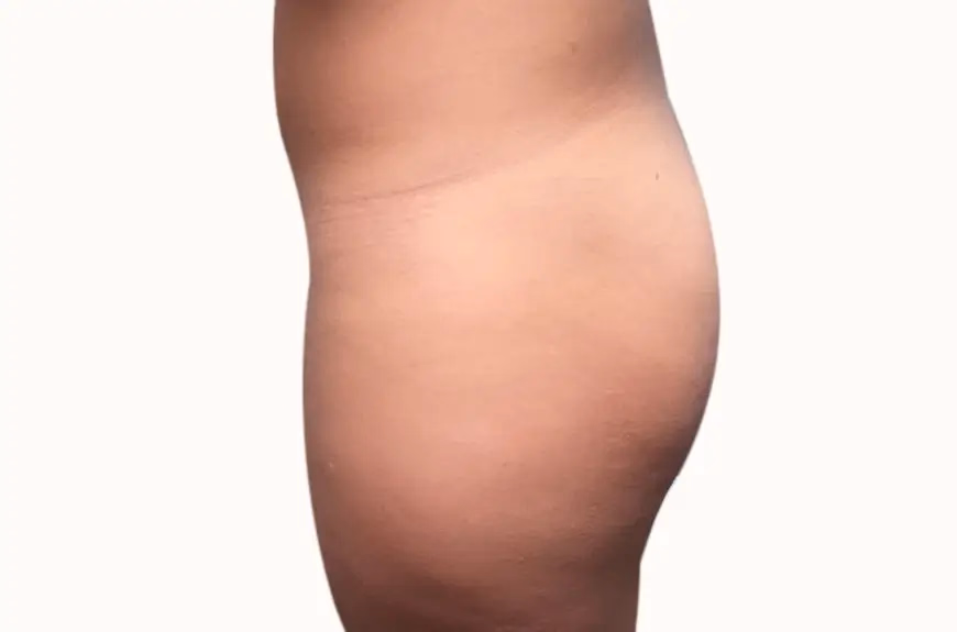 Antes de Augment de glutis