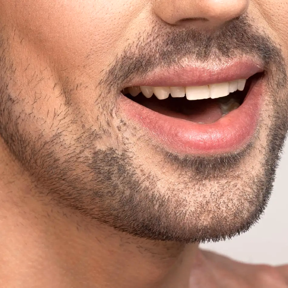 Què és la marcació mandibular amb àcid hialurònic?