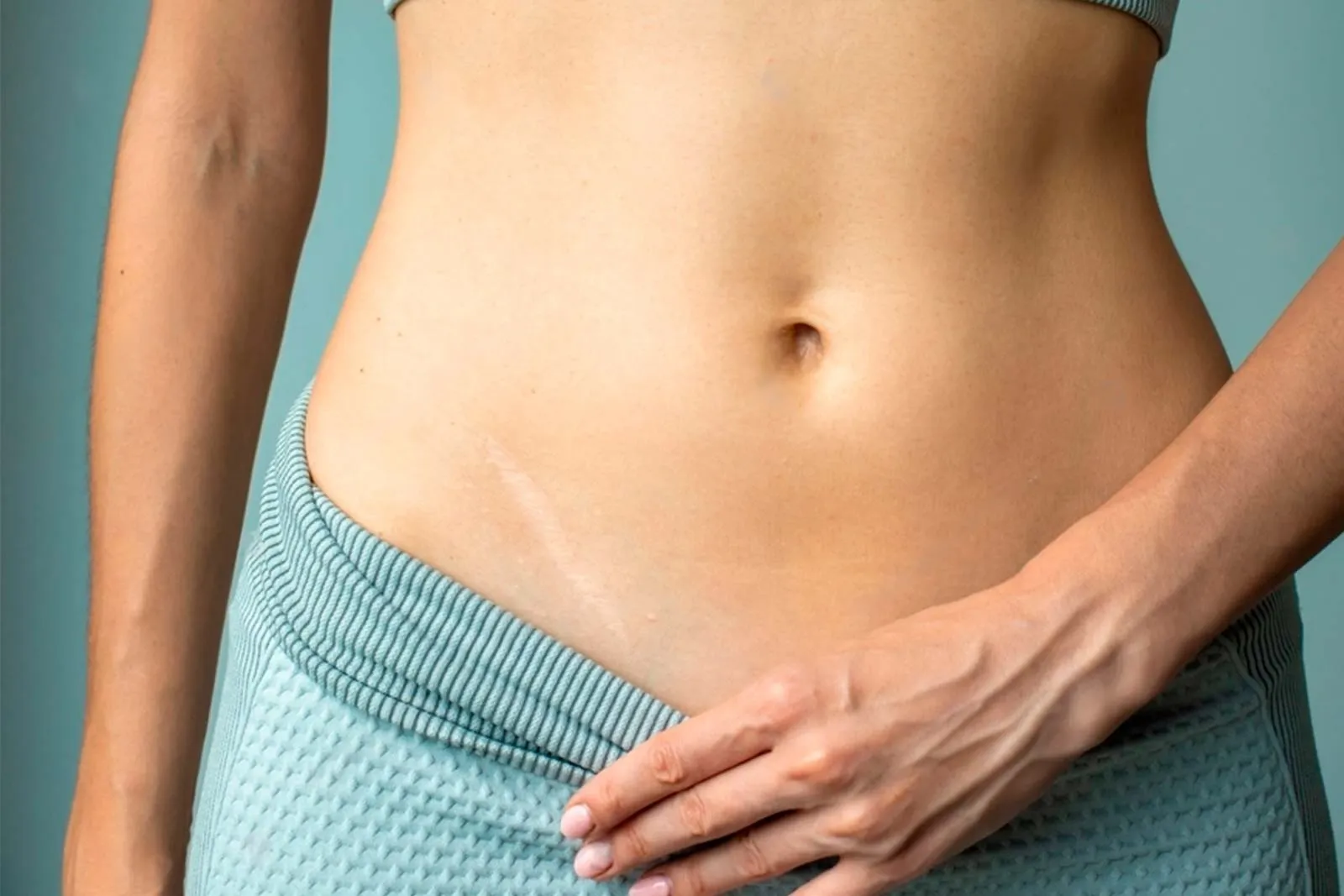 Eliminar cicatrices: Luce una piel sin imperfecciones.