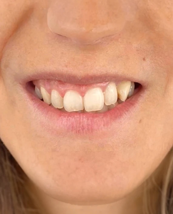 Antes de Somriure gingival