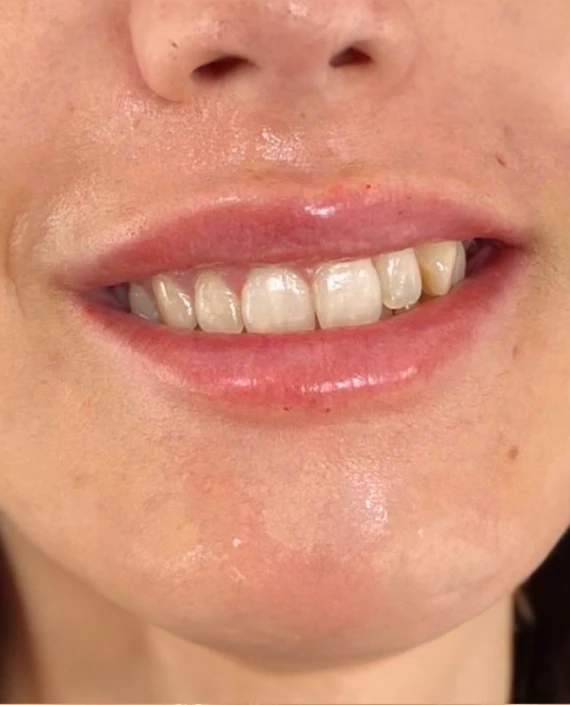 Después de Somriure gingival