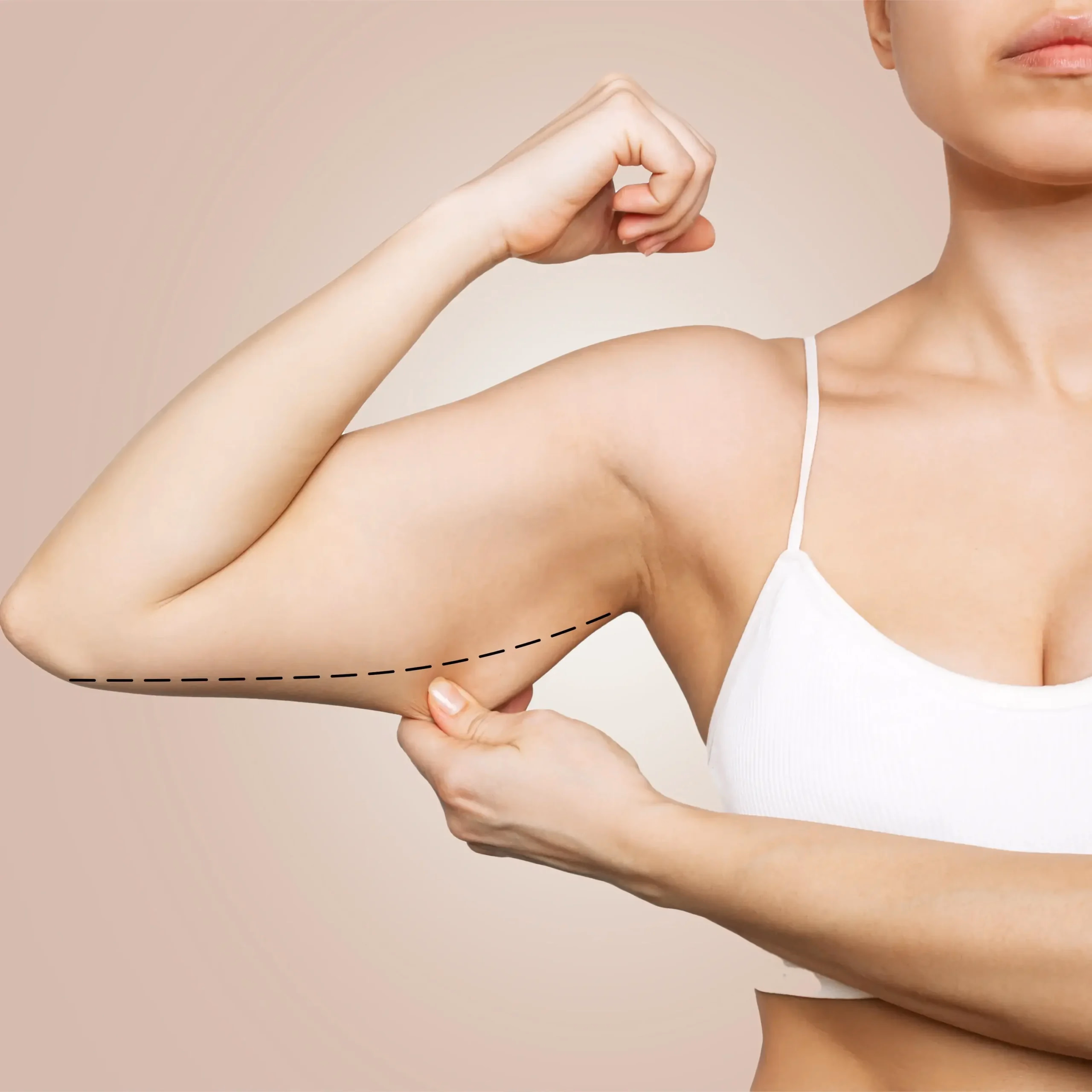 How is an arm lift (Brachioplasty) procedure performed?
