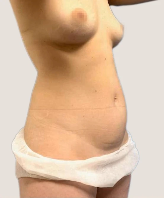 Antes de Lipoescultura