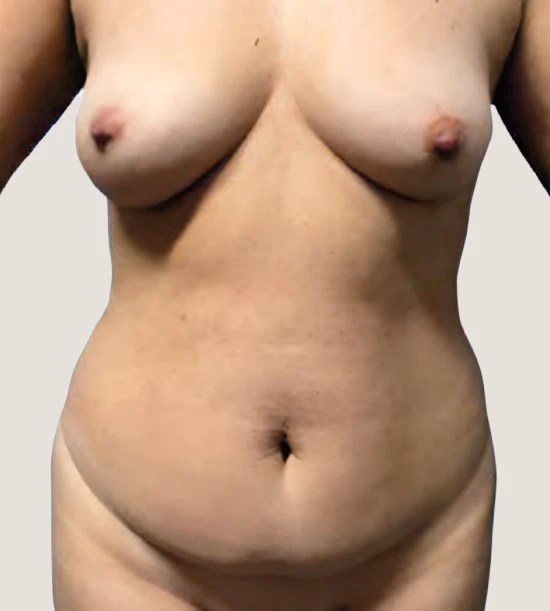 Antes de Lipoescultura