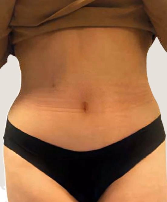 Después de Lipoescultura
