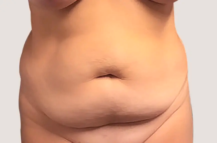 Antes de Liposucció VASER