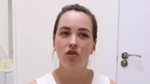 Yaiza’s result with her mastopexy